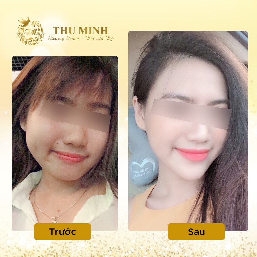 Độn cằm v line vĩnh viễn công nghệ chuẩn Hàn Quốc